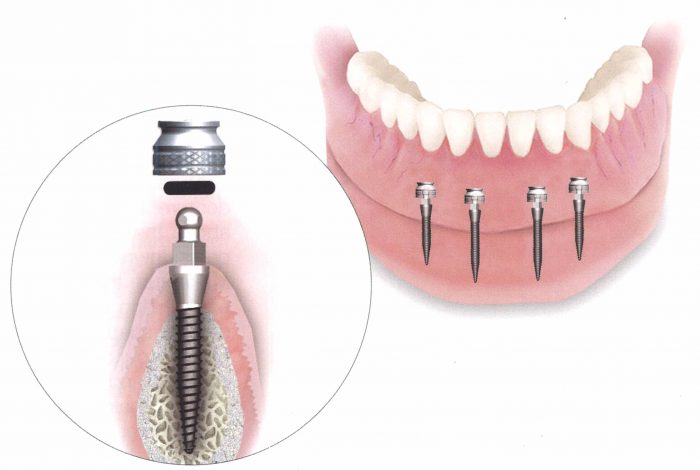 Mini Dental Implants Near Me | All on 4 Dental Implants Houston