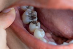 What Are The Benefits Of Getting A Dental Filling?