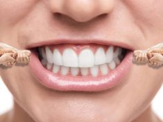 Invisalign Near Me Online Search