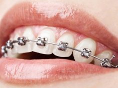 Advantages Of Adult Orthodontics Near Me