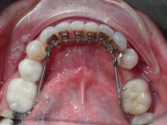 Comfort Dental Braces in Miami, Fl