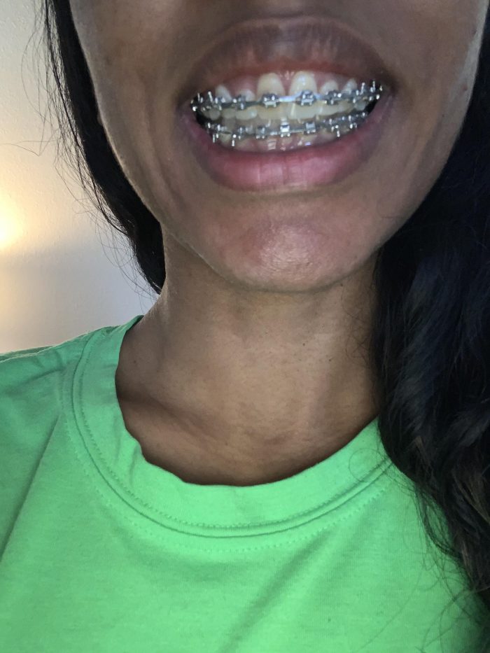 What Are The Best Braces Colors?