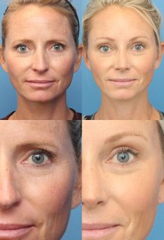 Endoscopic Brow Lift