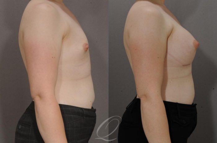 Breast Augmentation Before After