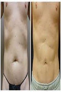 Vaser Liposuction Houston, TX | Abdominal Liposuction |Premiere Surgical Arts