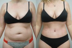 Liposuction Results Before And After