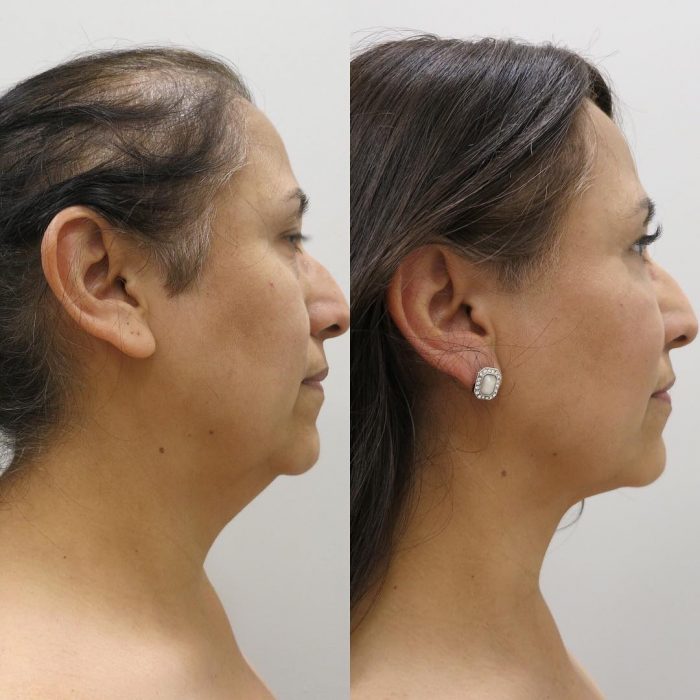 Benefits of Neck Liposuction