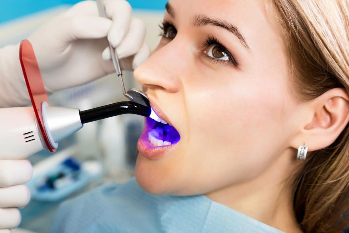 What Are The Benefits Of Getting A Dental Filling?