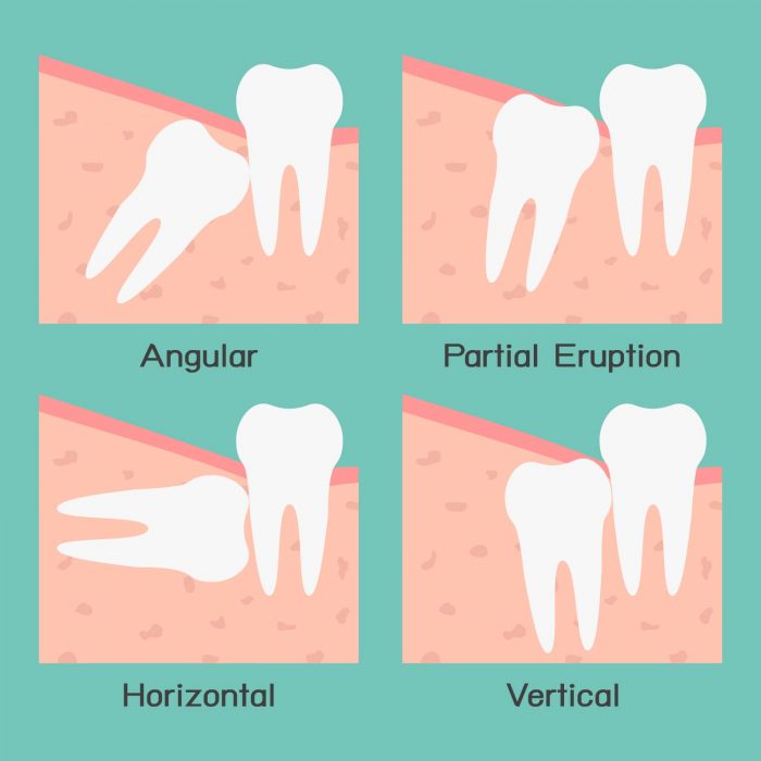 Wisdom Tooth Pain Relief | Wisdom Teeth Pain Symptoms