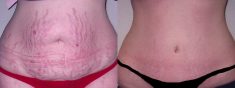 Tummy Tuck Before and After Pictures